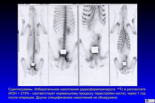 Сцинтиграммы. Избирательное накопление радиофармпрепарата  99 Т c  в реплантате (КОН = 219% - соответствует нормальному процессу перестройки кости), через 1 год после операции. Других специфических накоплений не обнаружено 