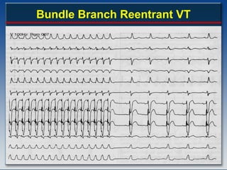 2006-VASCD-Guidelines-Slideset.ppt sudden cardiac death | PPT