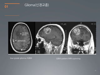 01                Glioma(싞경교종)




     low-grade glioma /GBM       GBM patient MRI scanning




                                                            11
 