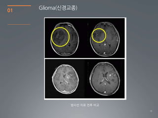 01   Glioma(싞경교종)




              방사선 치료 전후 비교
                             13
 