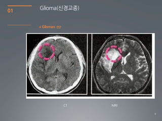 01   Glioma(싞경교종)


     4   Glioma의 진단




                      8
 