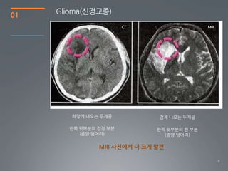 01   Glioma(싞경교종)
                       CT                   MRI




        하얗게 나오는 두개골          검게 나오는 두개골

       왼쪽 윗부분의 검정 부분         왼쪽 윗부분의 흰 부분
          (종양 덩어리)             (종양 덩어리)

               MRI 사진에서 더 크게 발견

                                                  9
 
