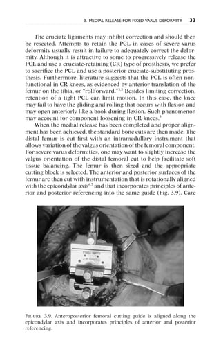 Varus Defor knee arthroplasty handbook | PDF