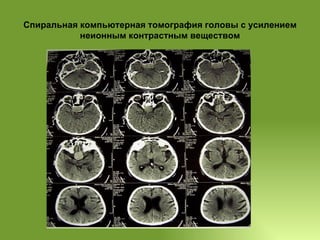 Спиральная компьютерная томография головы с усилением неионным контрастным веществом 