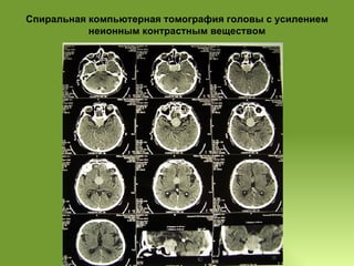 Спиральная компьютерная томография головы с усилением неионным контрастным веществом 