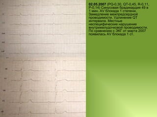 02.05.2007  (PQ-0,30, QT-0,45, R-0,11, P-0,14) Синусовая брадикардия 49 в 1 мин. AV блокада 1 степени. Замедление межпредсердной проводимости. Удлинение QT интервала. Местные неспецифические нарушение внутрижелудочковой проводимости. По сравнению с ЭКГ от марта 2007 появилась AV блокада 1 ст. 