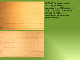 18.09.07.  Ритм синусовый, ЧСС - 58 уд в мин., регистрируется АВ-блокада 1 ст (РQ - 24 сек.). Отмечается улучшение процесса реполяризации миокарда боковой стенки. 