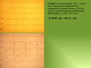 21.09.07.  Ритм синусовый, ЧСС - 75 уд в мин. Отмечается учащение ЧСС, сохраняются отрицательные з.Т в отв. V2-V5 с незначительным углублением. АВ-блокада 1 ст (РQ - 0,21 сек.). 21 .09.07   Na – 126, K – 5,0 