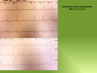 Суточное мониторирование ЭКГ  (22.09.2007) 