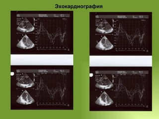 Эхокардиография 