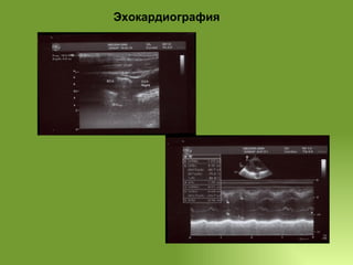 Эхокардиография 