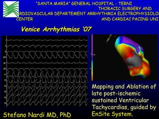 Stefano Nardi MD, PhD
““SANTA MARIA” GENERAL HOSPITAL - TERNISANTA MARIA” GENERAL HOSPITAL - TERNI
THORACIC SURGERY ANDTHORACIC SURGERY AND
CARDIOVASCULAR DEPARTEMENT ARRHYTHMIA ELECTROPHYSIOLOGCARDIOVASCULAR DEPARTEMENT ARRHYTHMIA ELECTROPHYSIOLOG
CENTER AND CARDIAC PACING UNITCENTER AND CARDIAC PACING UNIT
Venice Arrhythmias ‘07Venice Arrhythmias ‘07
Mapping and Ablation ofMapping and Ablation of
late post-ischemiclate post-ischemic
sustained Ventricularsustained Ventricular
Tachycardias, guided byTachycardias, guided by
EnSite System.EnSite System.
 