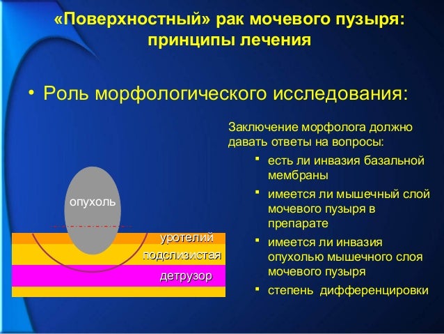 Лечение рака мочевого пузыря