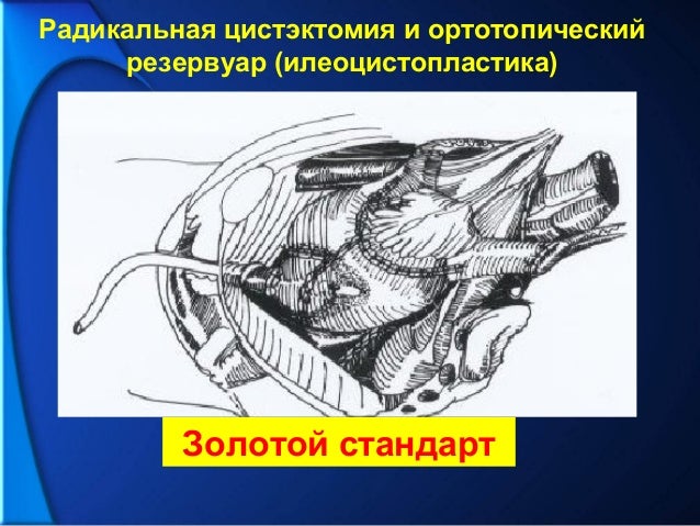 Лечение рака мочевого пузыря