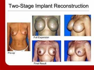 Two-Stage Implant Reconstruction Pre-op Full Expansion Final Result 