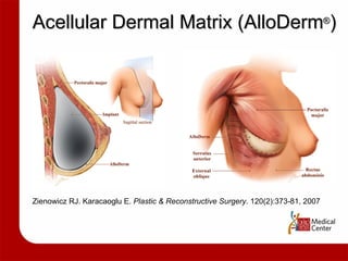 Acellular Dermal Matrix (AlloDerm ® ) Zienowicz RJ. Karacaoglu E.  Plastic & Reconstructive Surgery . 120(2):373-81, 2007 