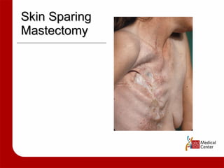 Skin Sparing Mastectomy 