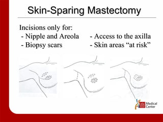 Skin-Sparing Mastectomy Incisions only for:  - Nipple and Areola   - Access to the axilla - Biopsy scars   - Skin areas “at risk” 