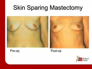 Pre-op Post-op Skin Sparing Mastectomy 