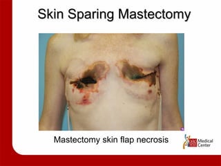 Skin Sparing Mastectomy Mastectomy skin flap necrosis 
