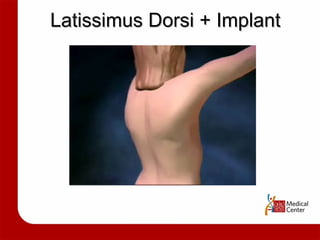 Latissimus Dorsi + Implant 