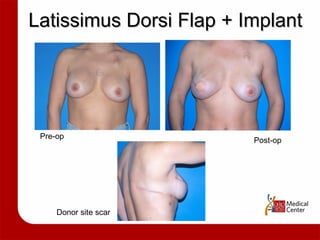 Latissimus Dorsi Flap + Implant Pre-op Post-op Donor site scar 