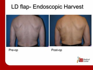 LD flap- Endoscopic Harvest Pre-op Post-op 