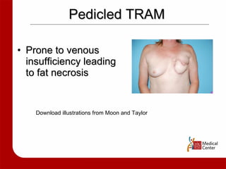 Pedicled TRAM Prone to venous insufficiency leading to fat necrosis  Download illustrations from Moon and Taylor 