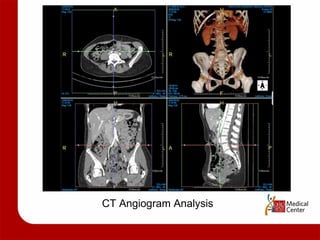 CT Angiogram Analysis 