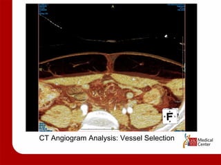 CT Angiogram Analysis: Vessel Selection 