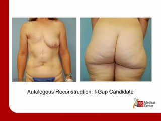 9/2/2008 9/2/2008 Autologous Reconstruction: I-Gap Candidate 