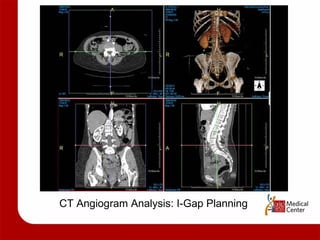 CT Angiogram Analysis: I-Gap Planning 