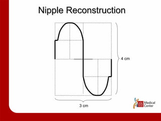 Nipple Reconstruction 3 cm 4 cm 