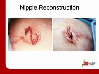 Nipple Reconstruction 