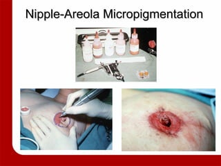 Nipple-Areola Micropigmentation 