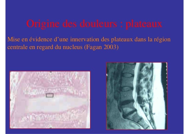 Le lumbago ceignant après la nourriture