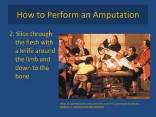 How to Perform an Amputation 2. Slice through the flesh with a knife around the limb and down to the bone Detail of Leg Amputation, artist unknown, mid-18 th  C. Carmichael and Ratzan.  Medicine: A Treasury of Art and Literature. 