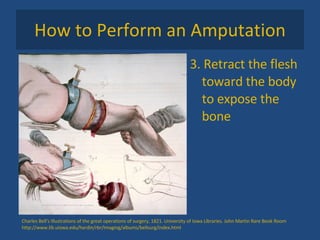 How to Perform an Amputation 3. Retract the flesh toward the body to expose the bone Charles Bell's Illustrations of the great operations of surgery, 1821. University of Iowa Libraries. John Martin Rare Book Room http://www.lib.uiowa.edu/hardin/rbr/Imaging/albums/bellsurg/index.html 