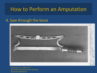 How to Perform an Amputation 4. Saw through the bone Amputation saw. c16thC ~24 in.  Germanisches National Museum Nürnberg.  http://www.bildindex.de 
