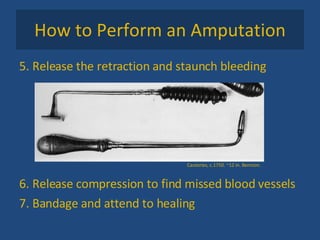 How to Perform an Amputation 5. Release the retraction and staunch bleeding 6. Release compression to find missed blood vessels 7. Bandage and attend to healing Cauteries, c.1750. ~12 in. Bennion. 