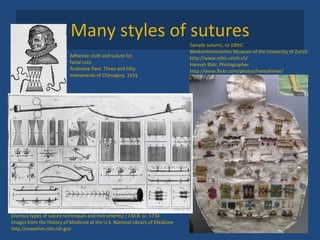 Many styles of sutures Adhesive cloth and suture for facial cuts.  Ambroise Pare. Three and Fifty Instruments of Chirurgery. 1631. Sample sutures, ca 18thC Medizinhistorisches Museum of the University of Zurich http://www.mhiz.unizh.ch/ Hannah Blair, Photographer http://www.flickr.com/photos/hannahmae/ [Various types of suture techniques and instruments] / J.M.B. sc. 1734 Images from the History of Medicine at the U.S. National Library of Medicine http://wwwihm.nlm.nih.gov 