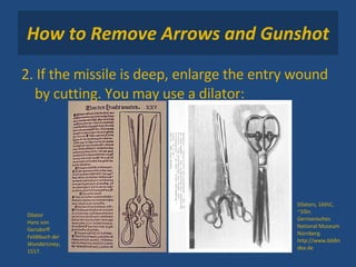 How to Remove Arrows and Gunshot 2. If the missile is deep, enlarge the entry wound by cutting. You may use a dilator: Dilator  Hans von Gersdorff Feldtbuch der Wundartzney , 1517. Dilators, 16thC, ~10in. Germanisches National Museum Nürnberg.  http://www.bildindex.de 
