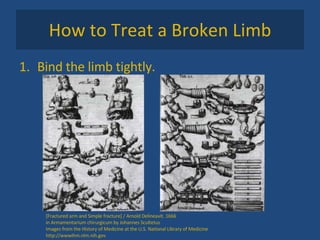 How to Treat a Broken Limb Bind the limb tightly. [Fractured arm and Simple fracture] / Arnold Delineavit. 1666 in Armamentarium chirurgicum by Johannes Scultetus Images from the History of Medicine at the U.S. National Library of Medicine http://wwwihm.nlm.nih.gov 
