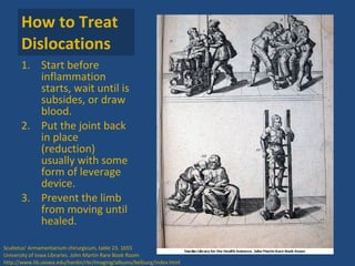 How to Treat Dislocations Start before inflammation starts, wait until is subsides, or draw blood. Put the joint back in place (reduction) usually with some form of leverage device.  Prevent the limb from moving until healed. Scultetus' Armamentarium chirurgicum, table 23. 1655 University of Iowa Libraries. John Martin Rare Book Room http://www.lib.uiowa.edu/hardin/rbr/Imaging/albums/bellsurg/index.html 
