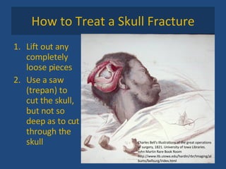 How to Treat a Skull Fracture Lift out any completely loose pieces Use a saw (trepan) to cut the skull, but not so deep as to cut through the skull Charles Bell's Illustrations of the great operations of surgery, 1821. University of Iowa Libraries. John Martin Rare Book Room http://www.lib.uiowa.edu/hardin/rbr/Imaging/albums/bellsurg/index.html 