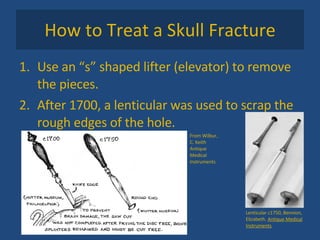 How to Treat a Skull Fracture Use an “s” shaped lifter (elevator) to remove the pieces. After 1700, a lenticular was used to scrap the rough edges of the hole. Lenticular c1750, Bennion, Elizabeth.  Antique Medical Instruments .  From Wilbur, C. Keith Antique Medical Instruments 