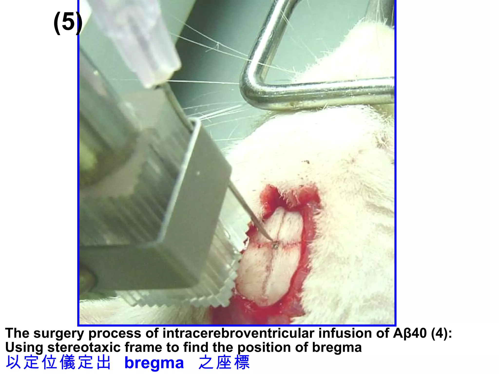 (5) The surgery process of intracerebroventricular infusion of Aβ40 (4): Using stereotaxic frame to find the position of bregma 以定位儀定出  bregma  之座標 