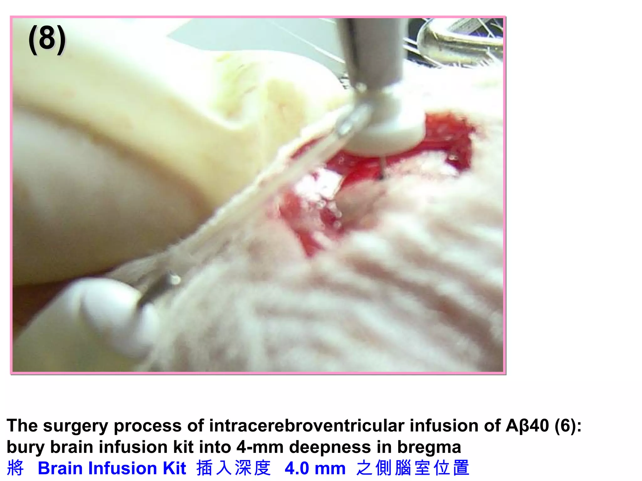 (8) The surgery process of intracerebroventricular infusion of Aβ40 (6):  bury brain infusion kit into 4-mm deepness in bregma 將  Brain Infusion Kit  插入深度  4.0 mm  之側腦室位置 