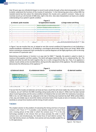 CIENTÍFICA, Volumen 5 N° 3/4, 2008



 Over 50 years ago one orthodontist began to record muscle activity through surface electromyography in an effort
 to better understand the functions of the muscles of mastication.1 In the intervening years since, surface EMG has
 revealed several key facts about the relationship between the muscles and a patient’s occlusion. Today we can
 routinely record up to 8 channels of EMG data, right in the clinic. And, data interpretation can lead us to a better
 understanding of our patient’s specific condition.
                                                        Figure 2.
   a) relaxed, quite muscles                     b) hyperactive muscles               c) large motor-unit firing




 In figure 2 we see muscles that are; a) relaxed at rest (the normal condition) b) hyperactive at rest (indicating a
 maxillo-mandibular malrelation) or 3) exhibiting a neurological abnormality (large motor-unit firing). While these
 factors routinely go unmeasured, their contribution to a precise diagnosis can be highly significant, even to the long-
 term outcome of a particular case.2-5

 Determining muscle balance in function is an easy task for EMG.6-13 Typically, the patient is asked to clench in
 maximum intercuspation and then swallow. The clench will appear balanced (fig. 3a.) or unbalanced (fig. 3b.). The
 swallow will either be with the teeth together (fig. 3c.) or with a tongue-thrust (fig. 3d.). Then, if an appliance is
 utilized, muscle activity can be recorded before, during and after adjustment of the appliance. This will immediately
 demonstrate the effectiveness of the appliance.14-20


                                                    Figure 3.
   a) balanced clench            b) unbalanced clench       c) normal swallow                   d) aberrant swallow




 If we see that the muscles are balanced, we know we have a result that will remain stable. But, if the muscles are not
 in balance, we can’t tell from the EMG recordings along exactly what to do about it. While much has been learned
 about muscle hyperactivity and the various conditions of imbalance that can exist within the masticatory musculature,
 EMG is not, nor will it likely ever be, adequate to the task of directing case treatment by itself. While surface EMG is
 a fast, easy and reliable way to record the relative contraction levels of the muscles at rest or in function, it has a low
 sensitivity to occlusal force locations and the timing of tooth contacts.

 T-SCAN II

 The simplest solution to the problem of evaluating the timing and force of occlusal
 contacts is the T-Scan II.21-23 It provides a very sensitive measure of contact force
 and a moving picture of the order in which the contacts occur.24-32 It is the only
 technology available to the clinician that can show precisely the order in which
 contacts occur and simultaneously, the relative force of each distinct contact. The
 new high density sensors are flexible, more precise and very durable (usable for up
 to 30 registrations).
                                                                                               Figure 4. The T-Scan II


                                                           178
 