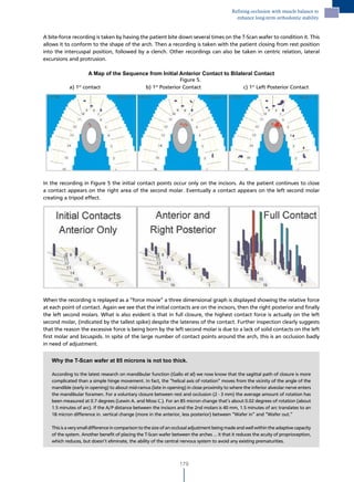 Refining occlusion with muscle balance to
                                                                                                enhance long-term orthodontic stability


A bite-force recording is taken by having the patient bite down several times on the T-Scan wafer to condition it. This
allows it to conform to the shape of the arch. Then a recording is taken with the patient closing from rest position
into the intercuspal position, followed by a clench. Other recordings can also be taken in centric relation, lateral
excursions and protrusion.

                    A Map of the Sequence from Initial Anterior Contact to Bilateral Contact
                                                        Figure 5.
           a) 1st contact               b) 1st Posterior Contact                c) 1st Left Posterior Contact




In the recording in Figure 5 the initial contact points occur only on the incisors. As the patient continues to close
a contact appears on the right area of the second molar. Eventually a contact appears on the left second molar
creating a tripod effect.




         Figure 6. Force movie frames




When the recording is replayed as a “force movie” a three dimensional graph is displayed showing the relative force
at each point of contact. Again we see that the initial contacts are on the incisors, then the right posterior and finally
the left second molars. What is also evident is that in full closure, the highest contact force is actually on the left
second molar, (indicated by the tallest spike) despite the lateness of the contact. Further inspection clearly suggests
that the reason the excessive force is being born by the left second molar is due to a lack of solid contacts on the left
first molar and bicuspids. In spite of the large number of contact points around the arch, this is an occlusion badly
in need of adjustment.


   Why the T-Scan wafer at 85 microns is not too thick.

   According to the latest research on mandibular function (Gallo et al) we now know that the sagittal path of closure is more
   complicated than a simple hinge movement. In fact, the “helical axis of rotation” moves from the vicinity of the angle of the
   mandible (early in opening) to about mid-ramus (late in opening) in close proximity to where the inferior alveolar nerve enters
   the mandibular foramen. For a voluntary closure between rest and occlusion (2 - 3 mm) the average amount of rotation has
   been measured at 0.7 degrees (Lewin A. and Moss C.). For an 85 micron change that’s about 0.02 degrees of rotation (about
   1.5 minutes of arc). If the A/P distance between the incisors and the 2nd molars is 40 mm, 1.5 minutes of arc translates to an
   18 micron difference in. vertical change (more in the anterior, less posterior) between “Wafer in” and “Wafer out.”

   This is a very small difference in comparison to the size of an occlusal adjustment being made and well within the adaptive capacity
   of the system. Another benefit of placing the T-Scan wafer between the arches ... it that it reduces the acuity of proprioception,
   which reduces, but doesn’t eliminate, the ability of the central nervous system to avoid any existing prematurities.



                                                                    179
 